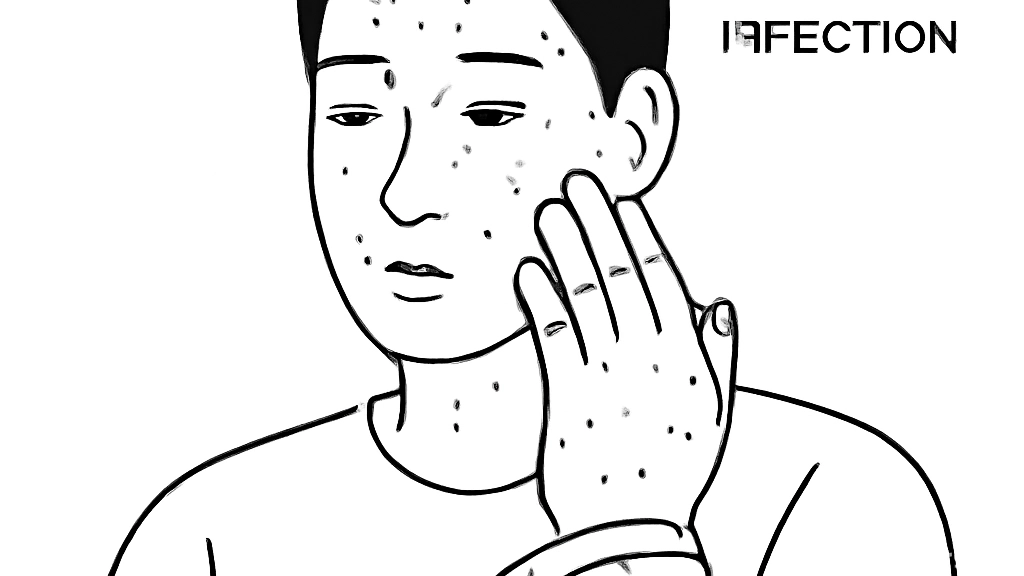 편평사마귀를 효과적…